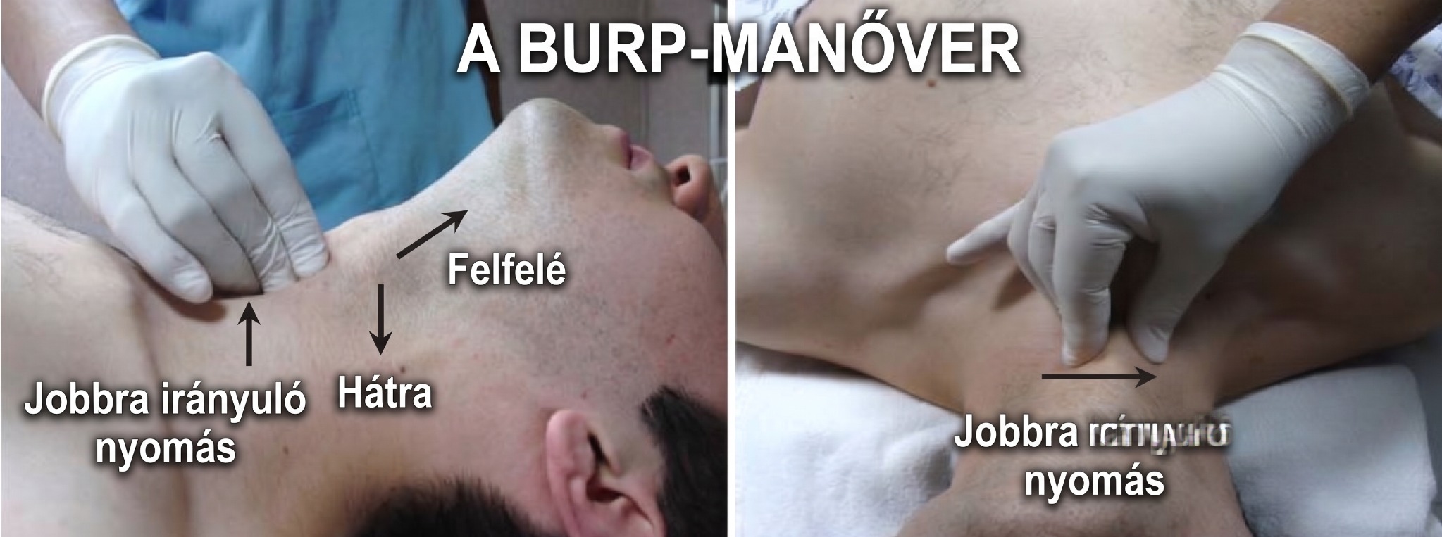 A BURP-manőver szemléltetése: a pajzsporcra gyakorolt hátrafelé, felfelé és jobbra irányuló nyomás.